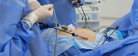 Лапароскопія